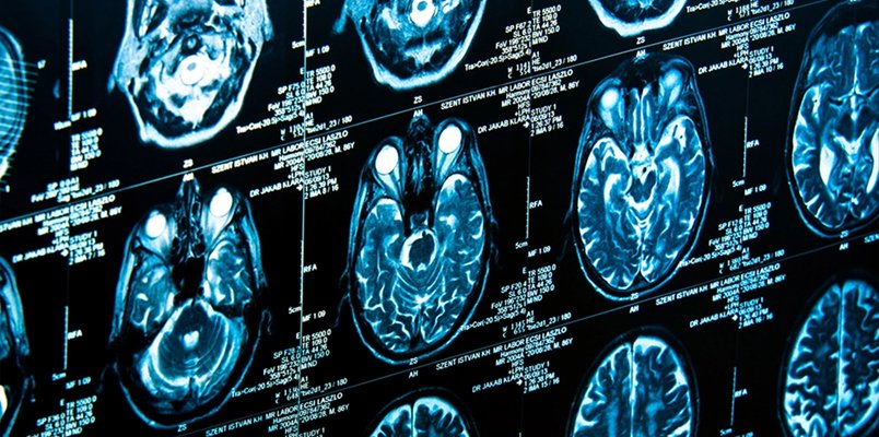 neuropanplaste freedom tomografia mozgu proti bolesti